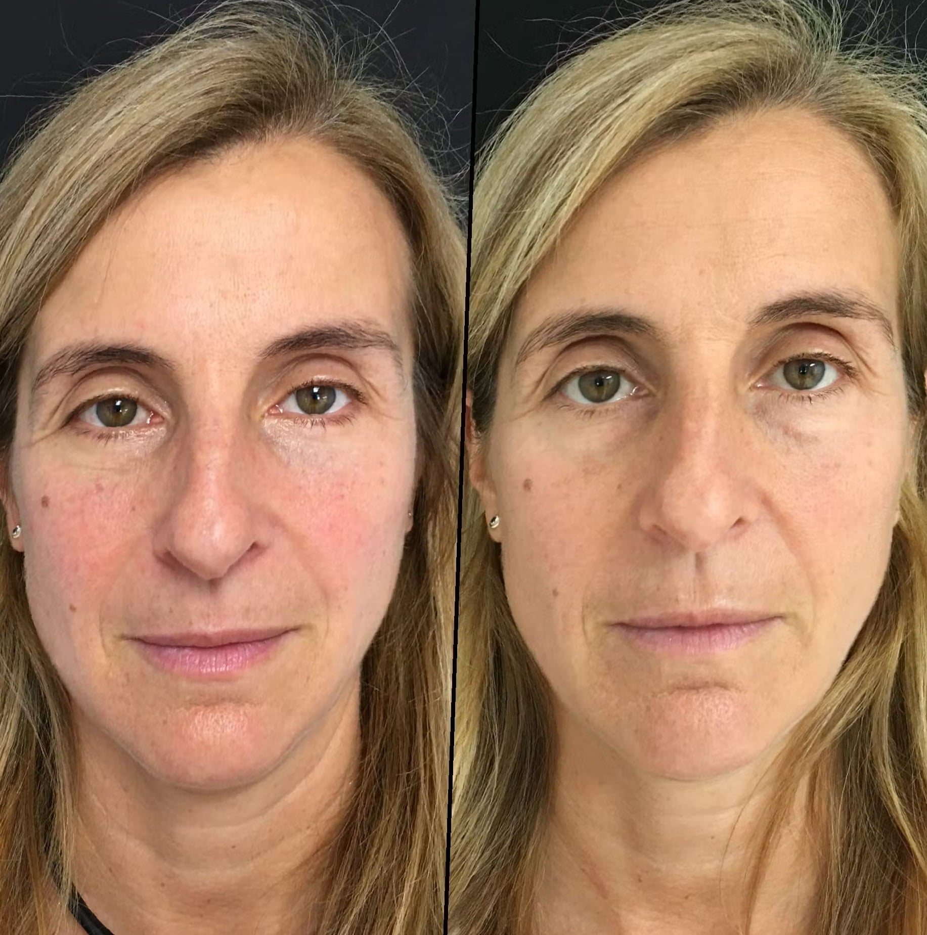 Blepharoplasty-Before-and-After-3