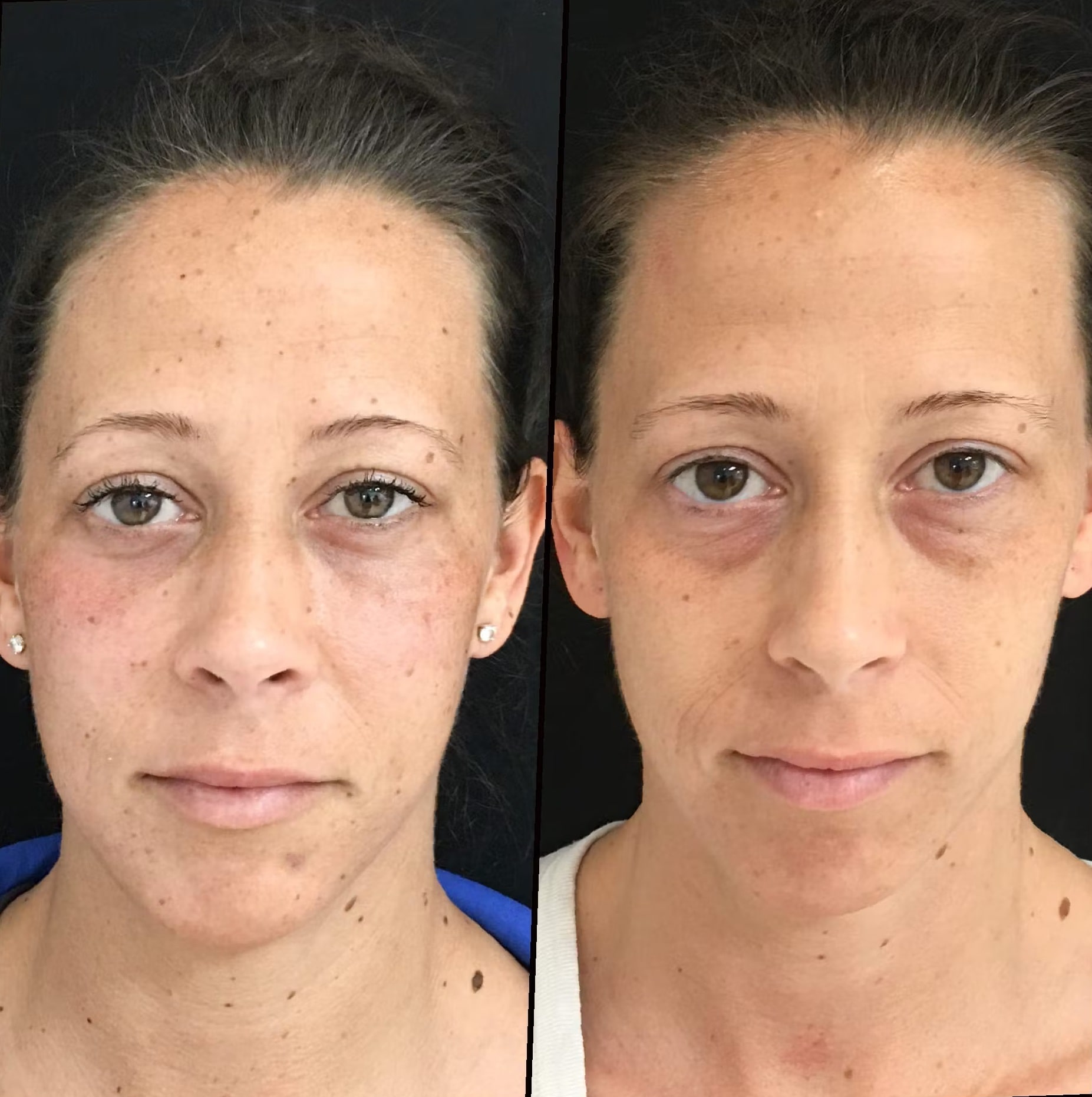 Blepharoplasty-Before-and-After-5