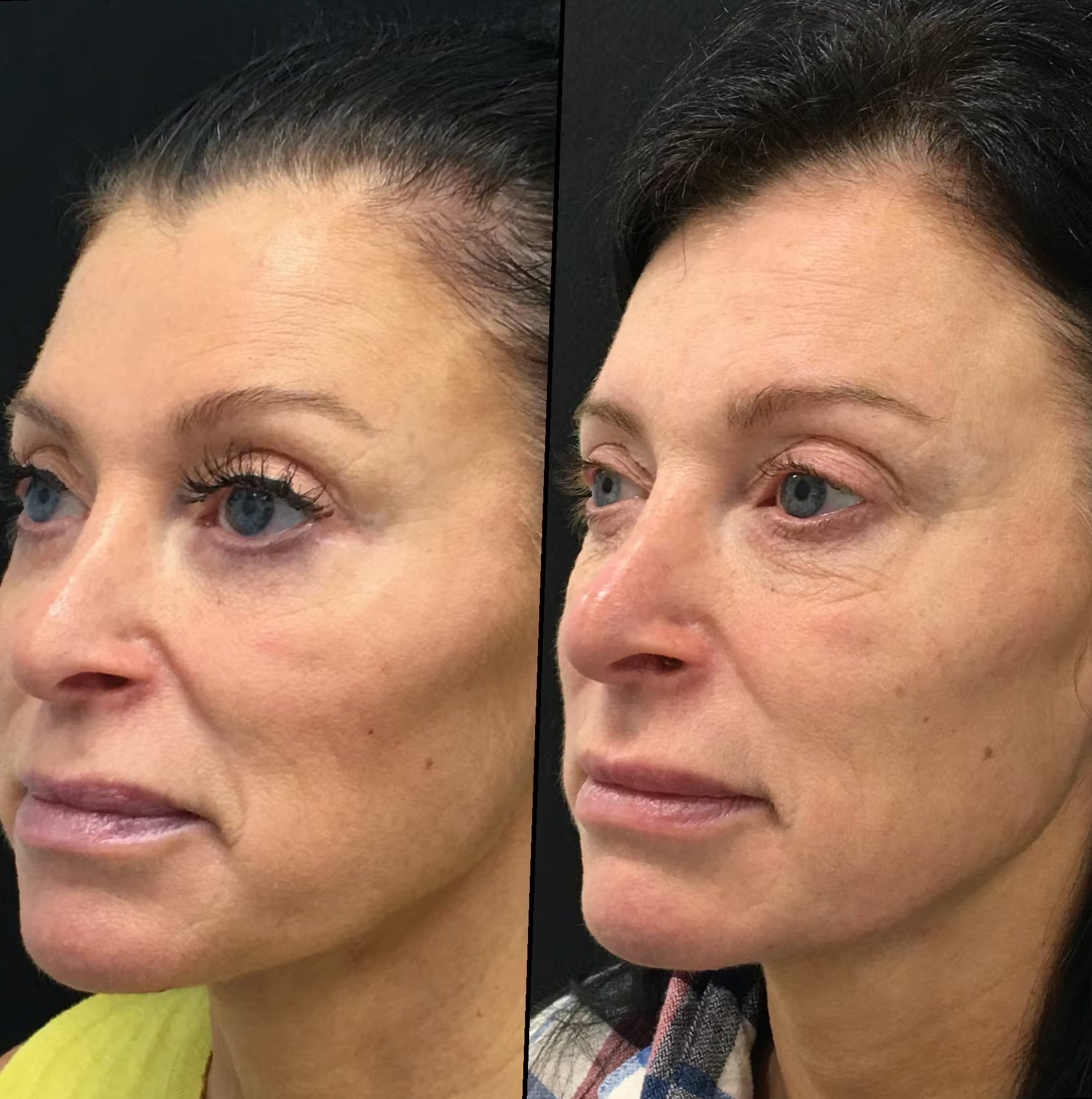 Blepharoplasty-Before-and-After-6