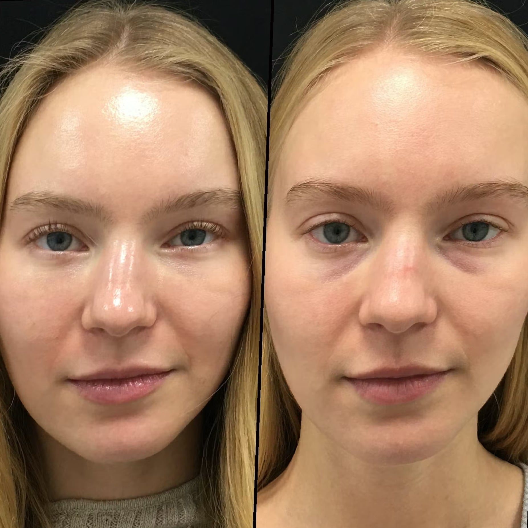 Blepharoplasty-Before-and-After-7