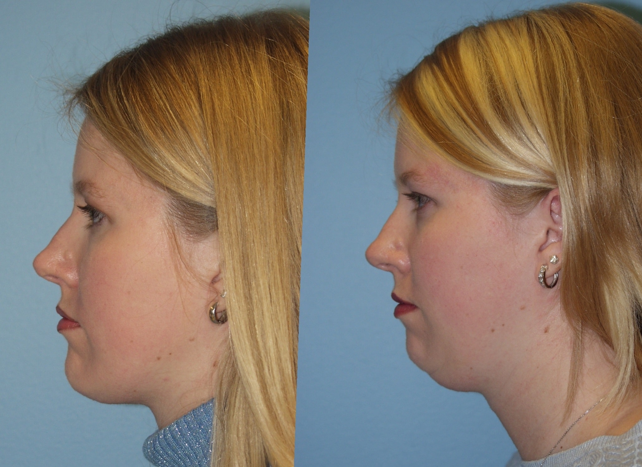 Chin-Lipo-Before-and-After-1