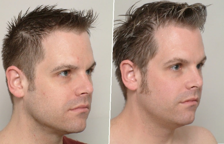 Chin-Lipo-Before-and-After-2