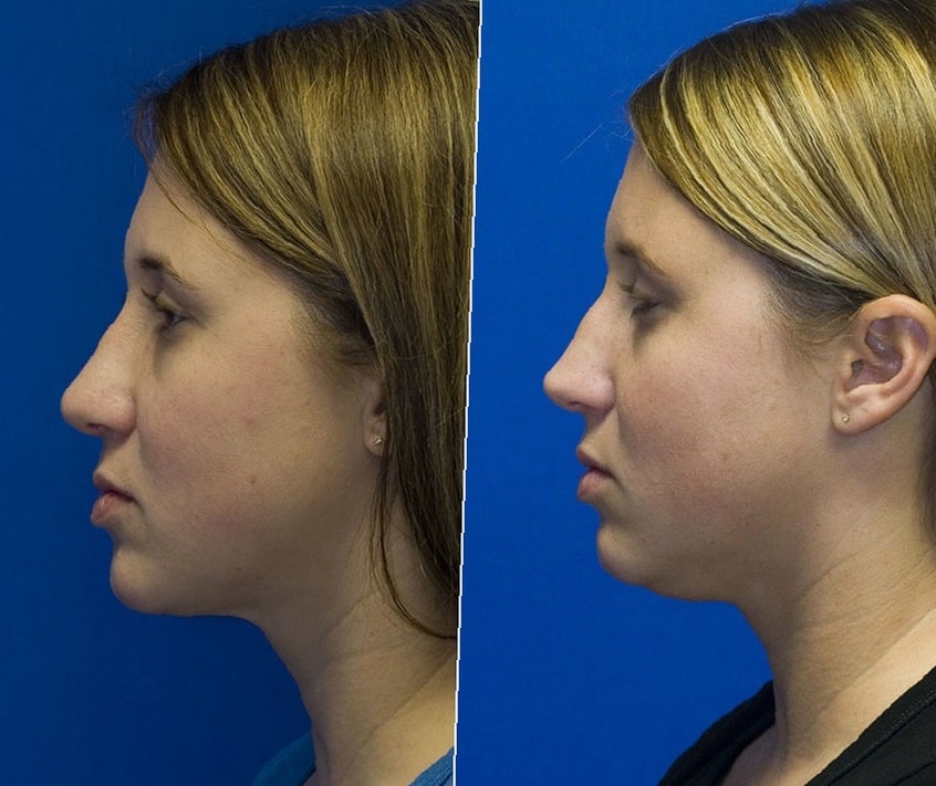 Chin-Lipo-Before-and-After-4