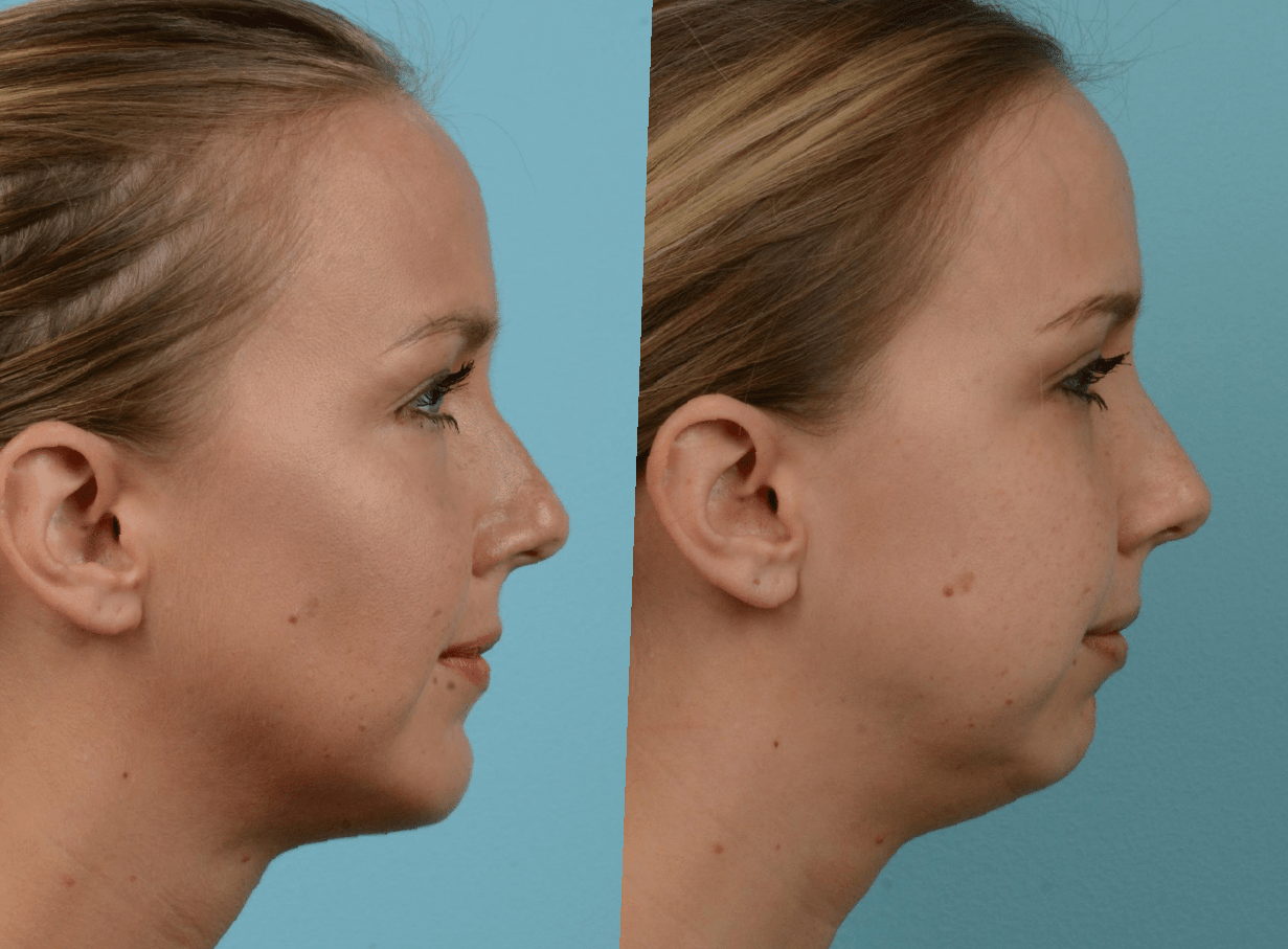 Chin-Lipo-Before-and-After-5