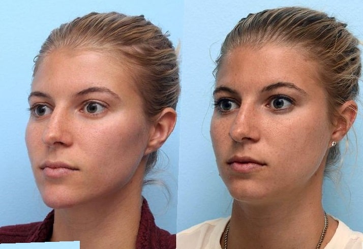 Chin-Lipo-Before-and-After-6