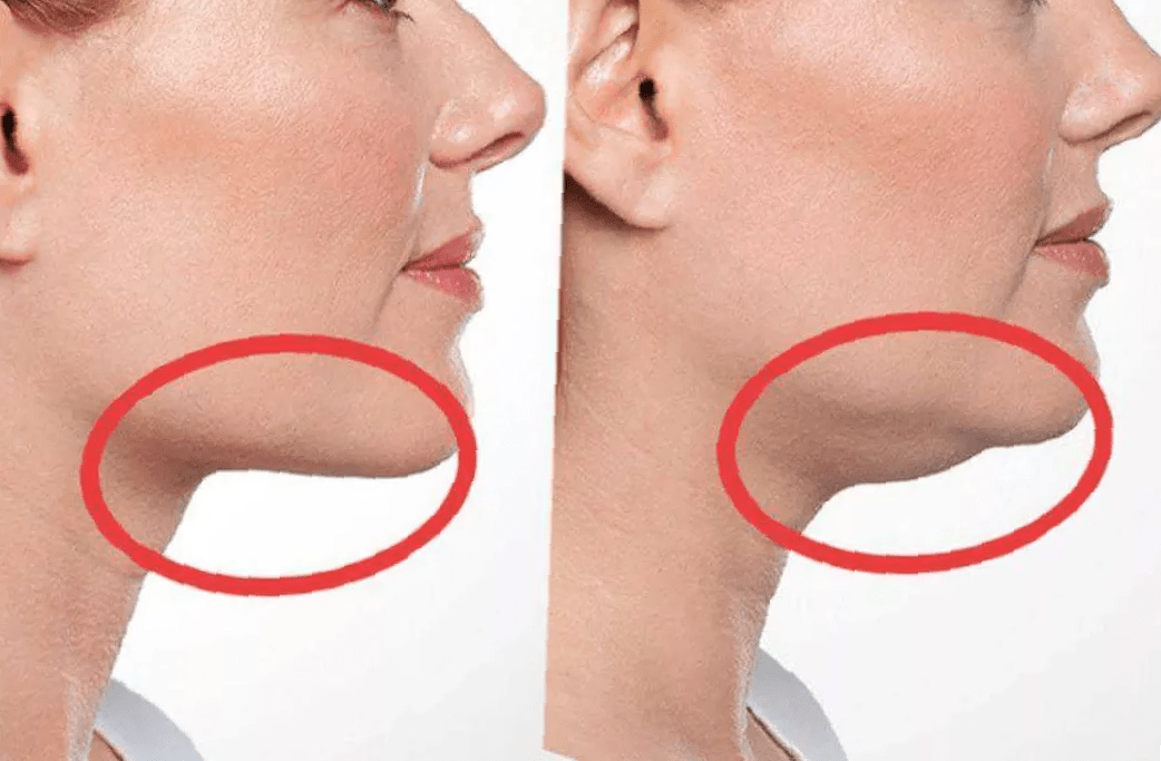 Chin-Lipo-Before-and-After-7