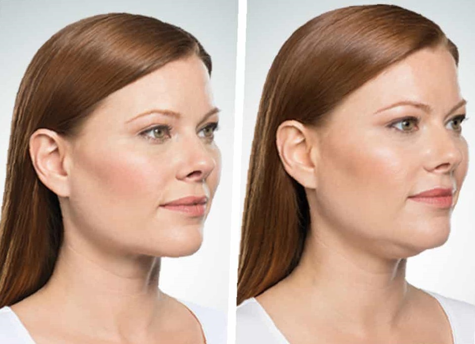 Chin-Lipo-Before-and-After-8