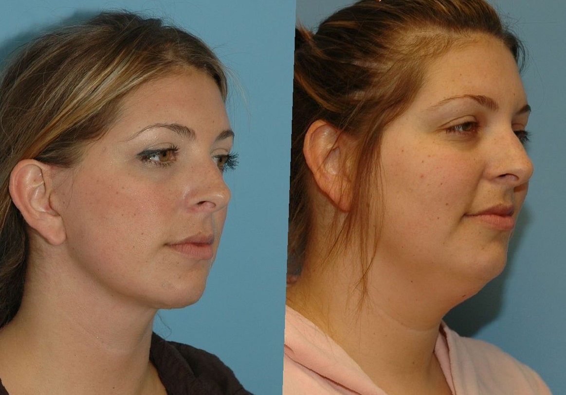 Chin-Lipo-Before-and-After-9