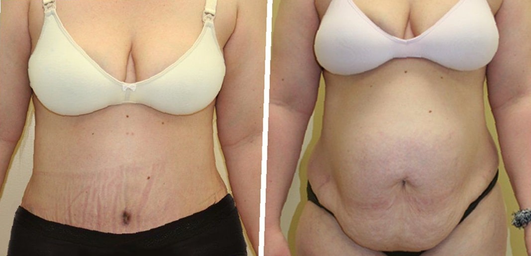 apron-belly-before-and-after-pictures-1