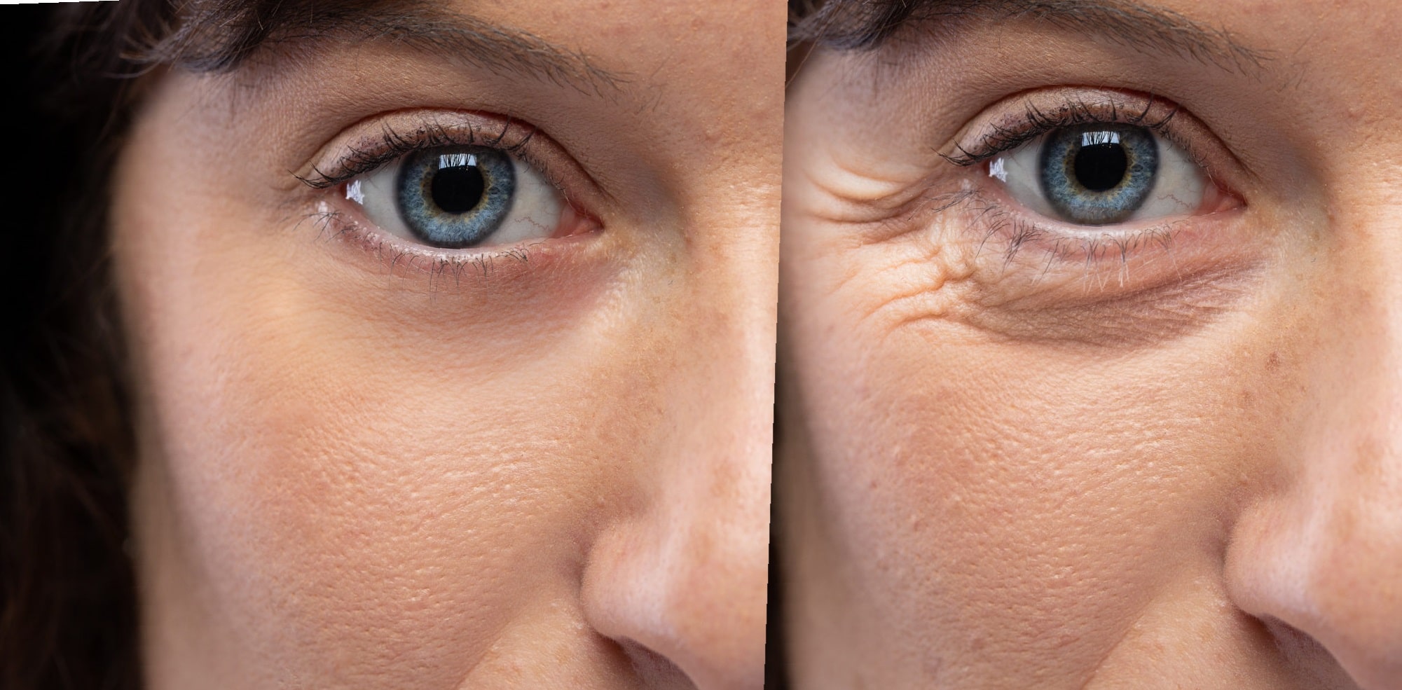 botox-before-and-after-crows-feet-22
