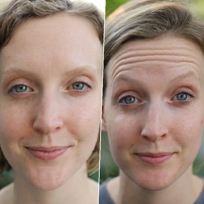 botox-forehead-before-and-after-4