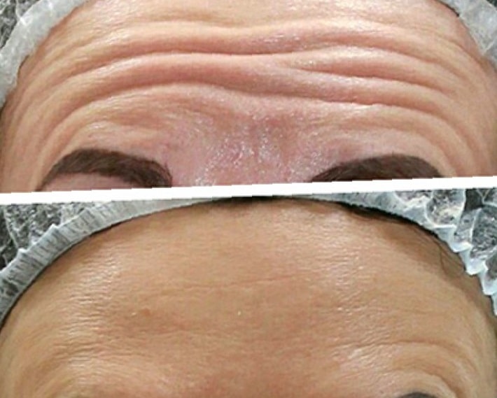 botox-forehead-before-and-after-8