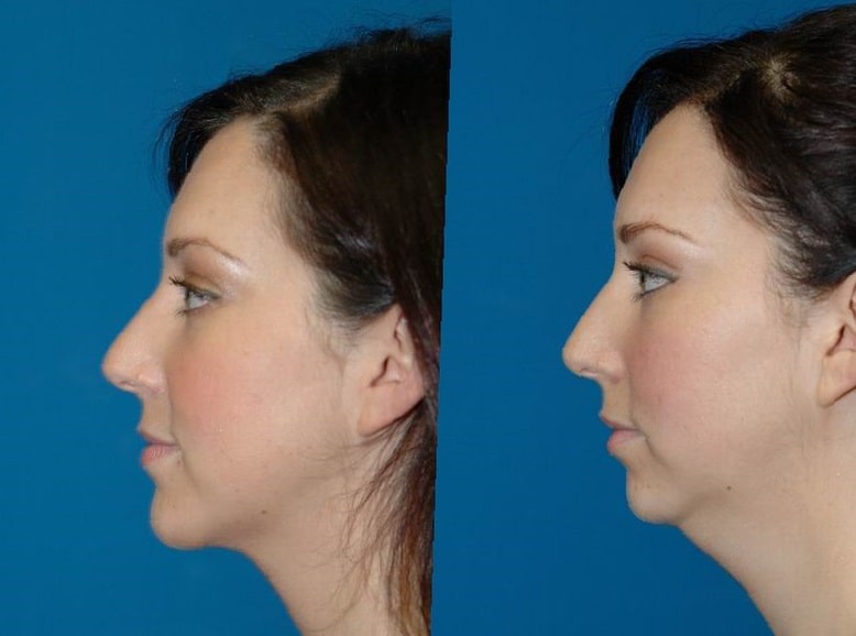 chin-implant-before-and-after-1