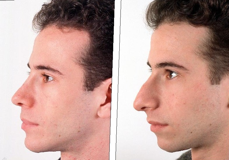 chin-implant-before-and-after-2