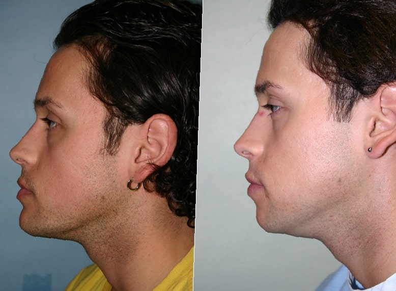 chin-implant-before-and-after-3