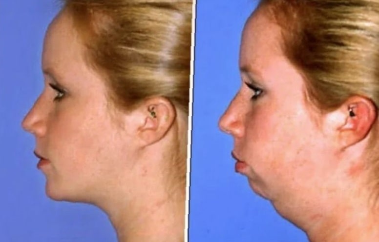 chin-implant-before-and-after-4