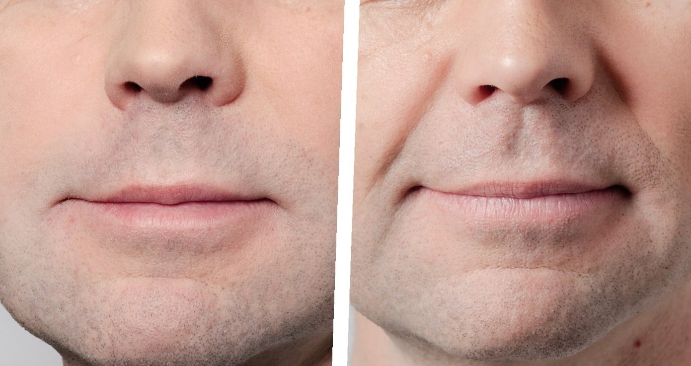 chin-implant-before-and-after-5