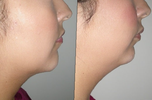 chin-implant-before-and-after-7