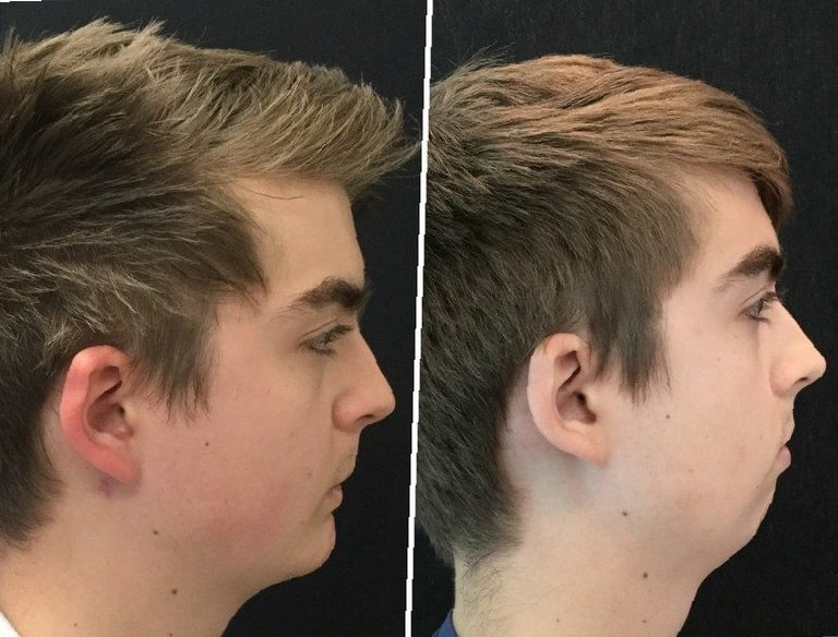 chin-implant-before-and-after-8