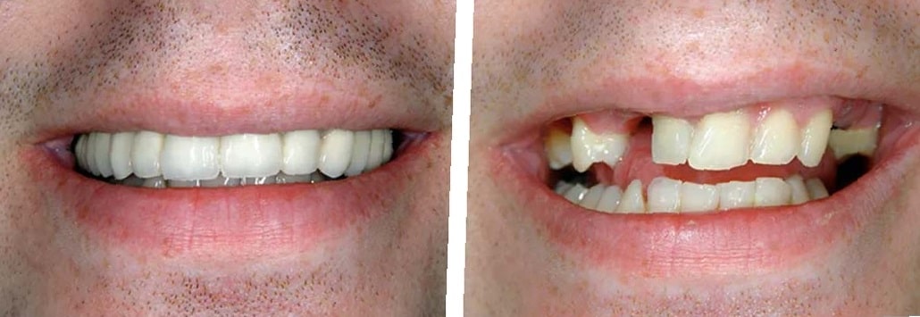 dental-bridge-before-and-after-1