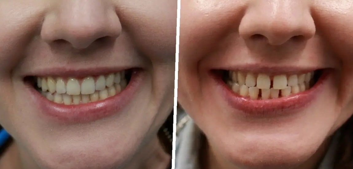 dental-bridge-before-and-after-2