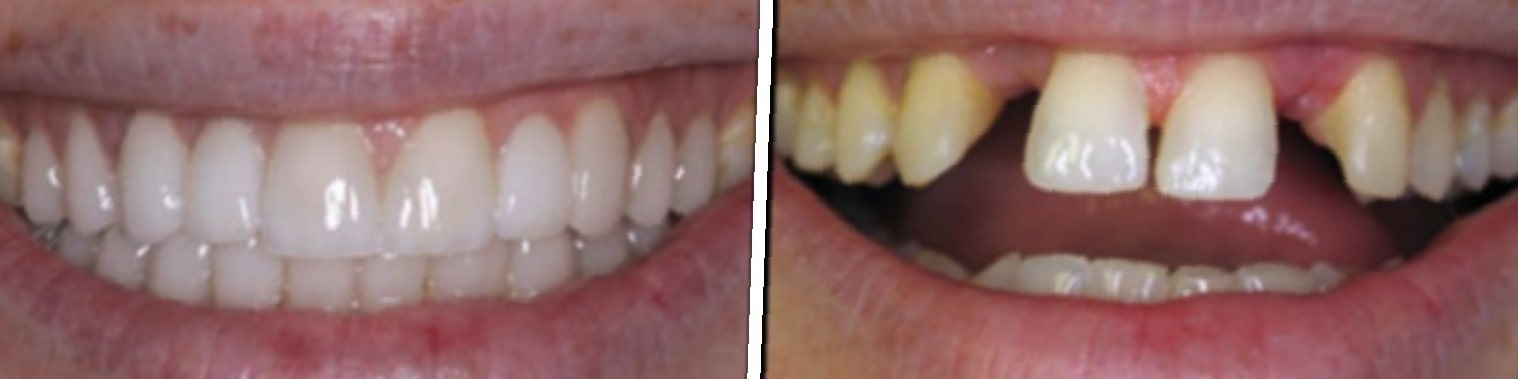 dental-bridge-before-and-after-3