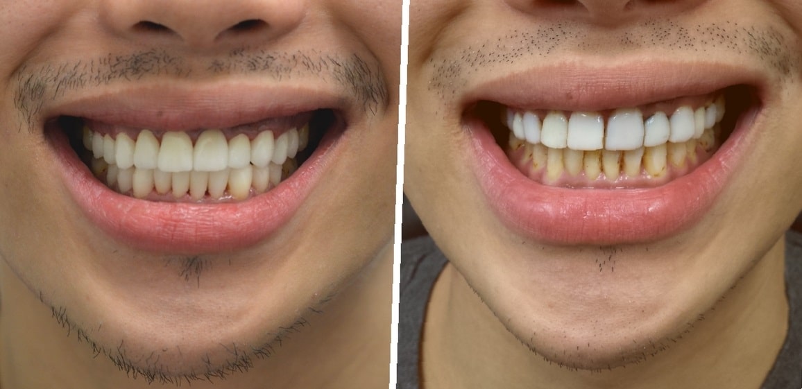 dental-bridge-before-and-after-4