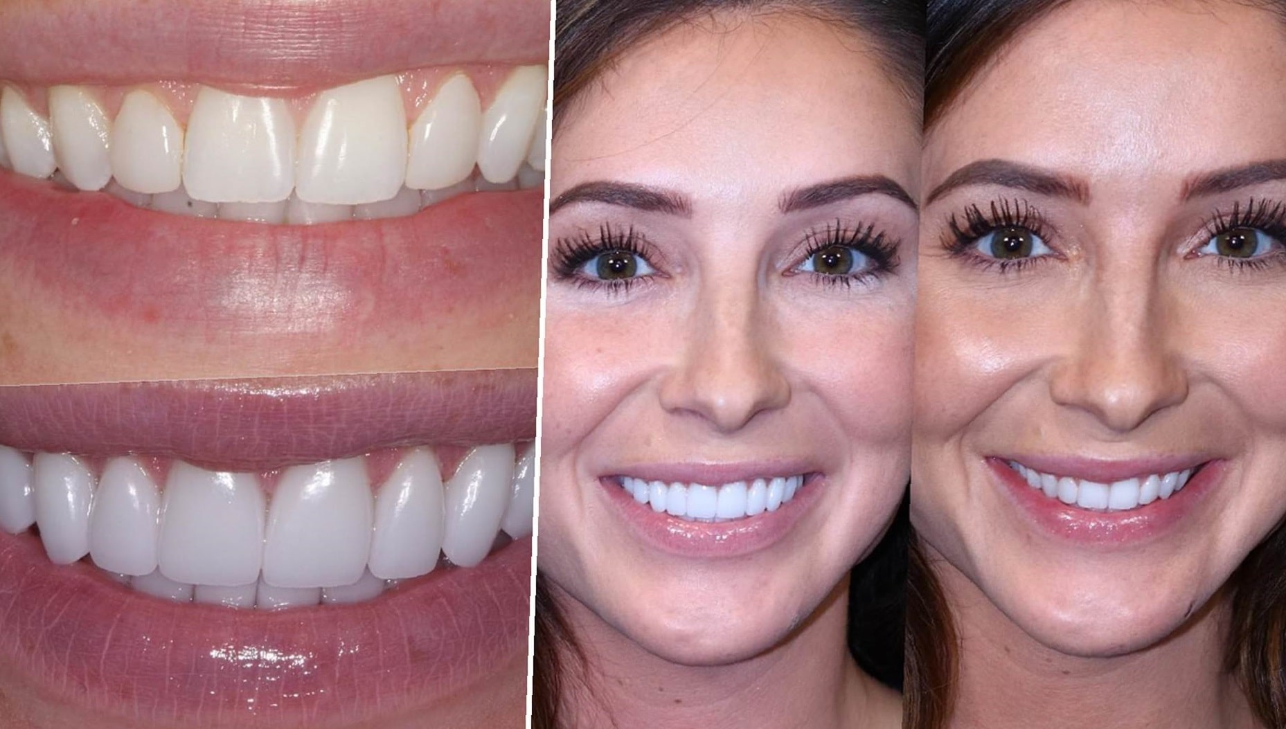dental-implants-before-and-after-21