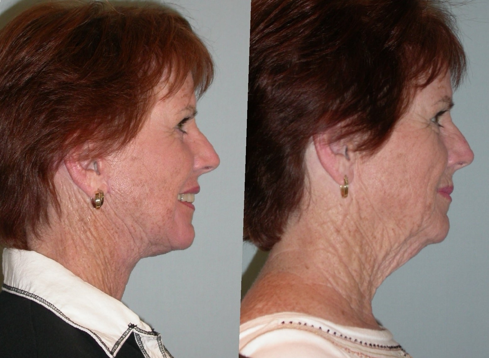 neck-lift-before-and-after-2