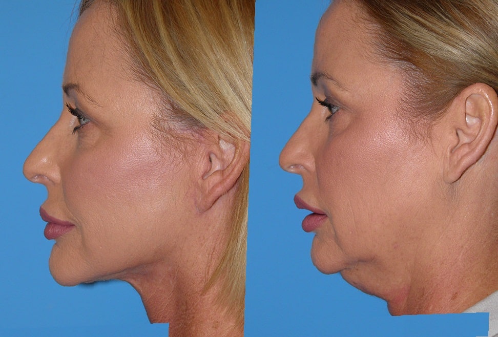 neck-lift-before-and-after-4