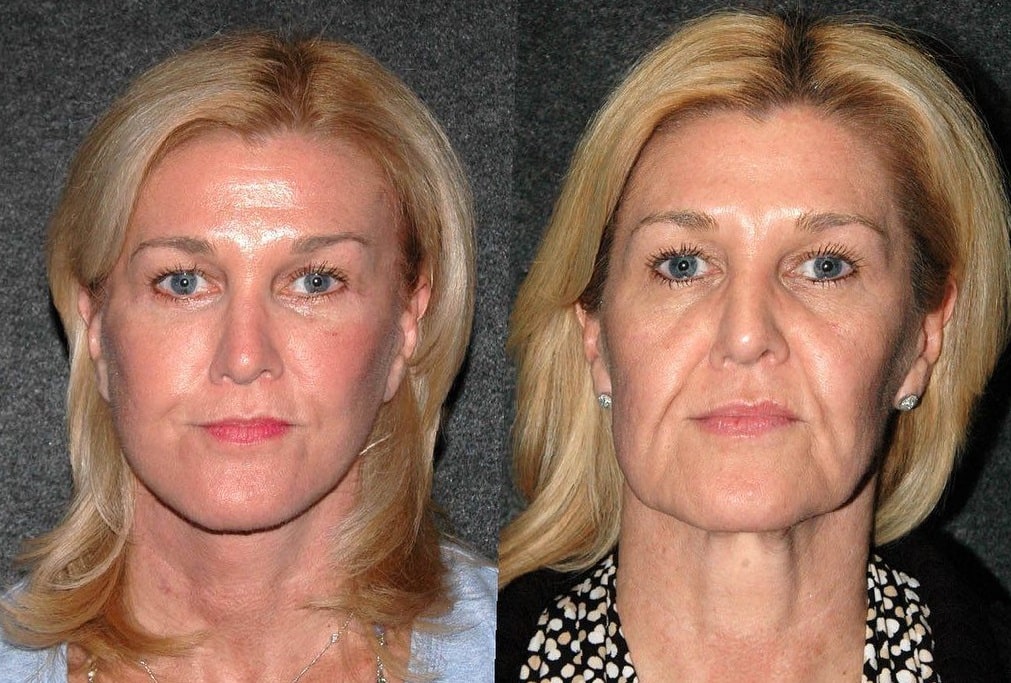 neck-lift-before-and-after-5