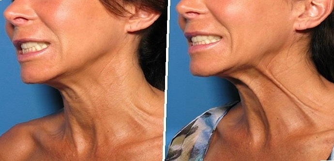 neck-lift-before-and-after-6