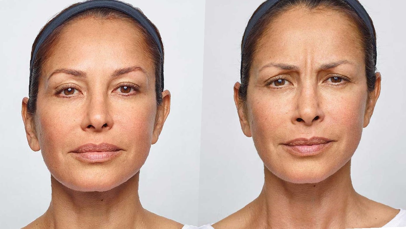 neck-lift-before-and-after-7