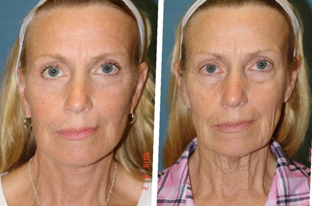 neck-lift-before-and-after-8