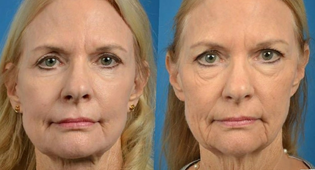 thermage-before-and-after-9