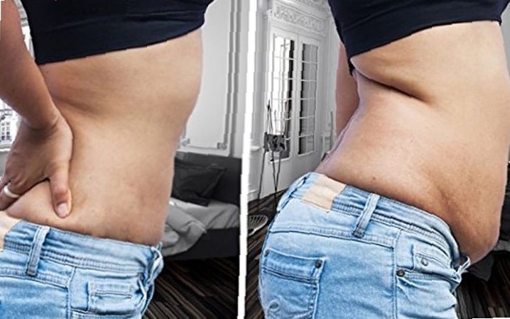 apron-belly-before-and-after-pictures-5