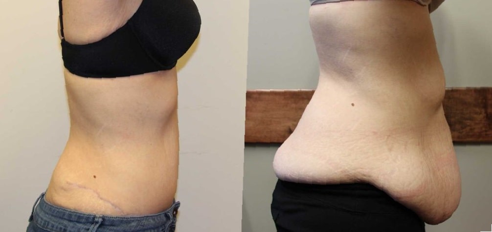 apron-belly-before-and-after-pictures-6