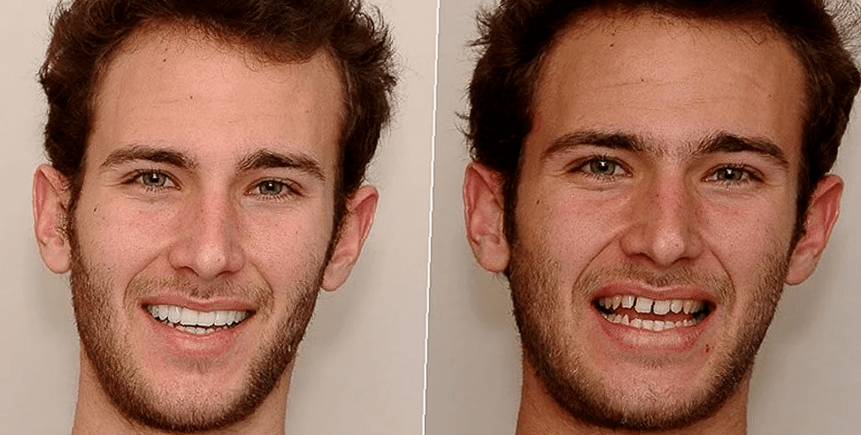 before-and-after-partial-dentures-3