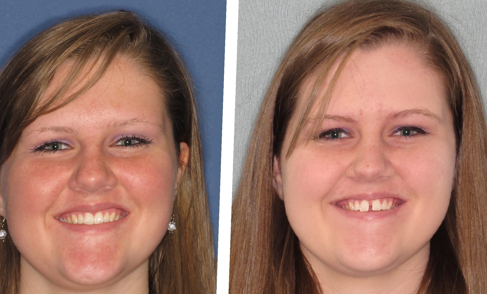 before-and-after-partial-dentures-4