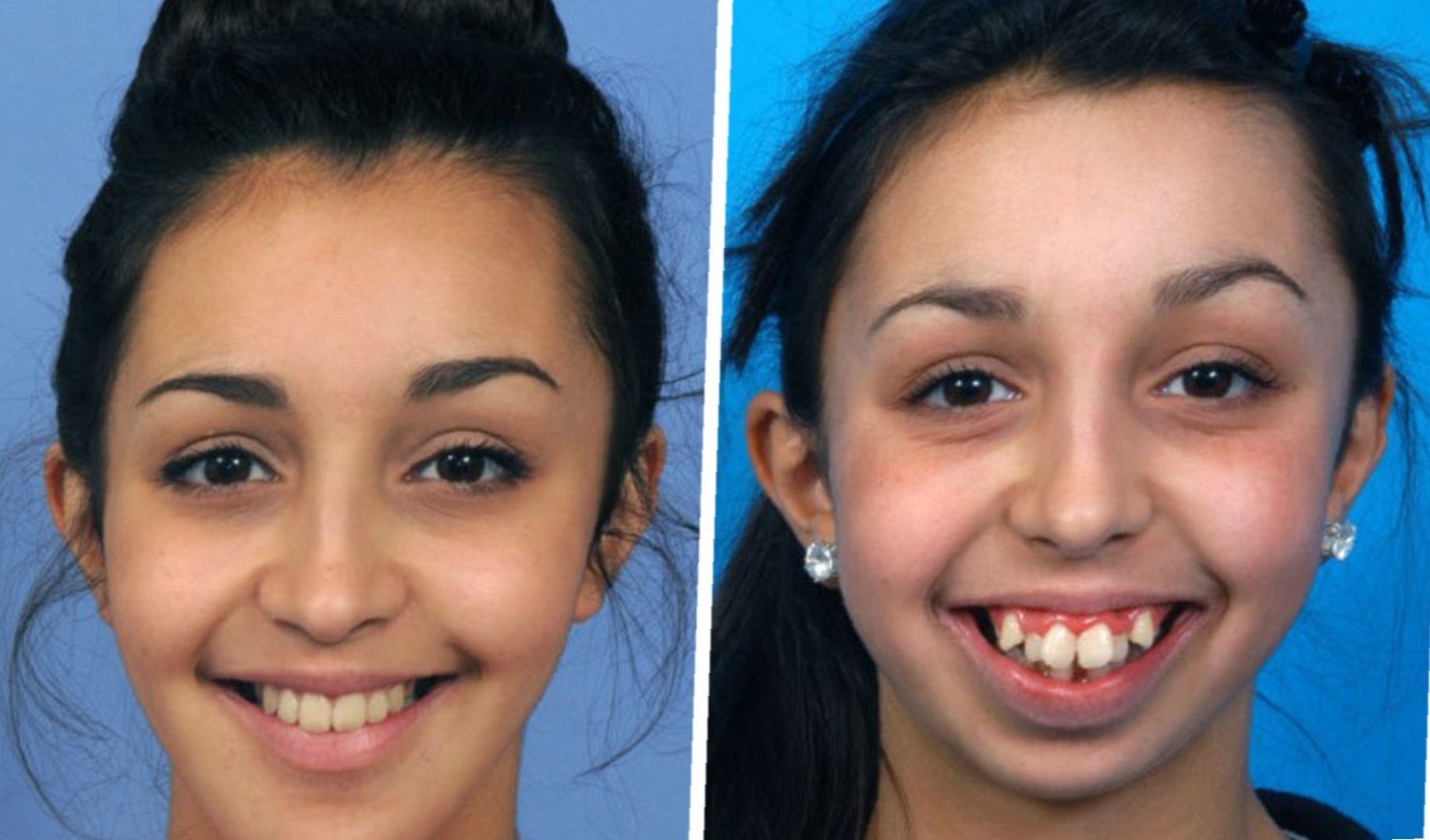 before-and-after-partial-dentures-5