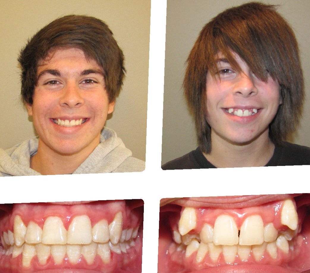 before-and-after-partial-dentures-7