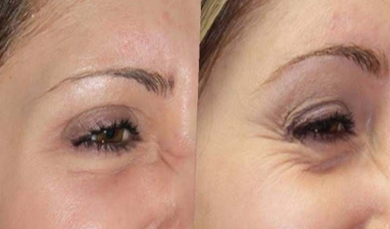 botox-before-and-after-crows-feet-26