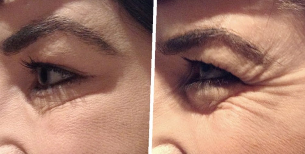 botox-before-and-after-crows-feet-27