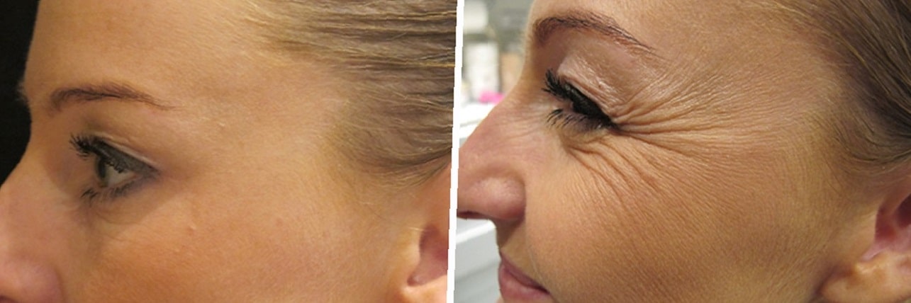 botox-before-and-after-crows-feet-28