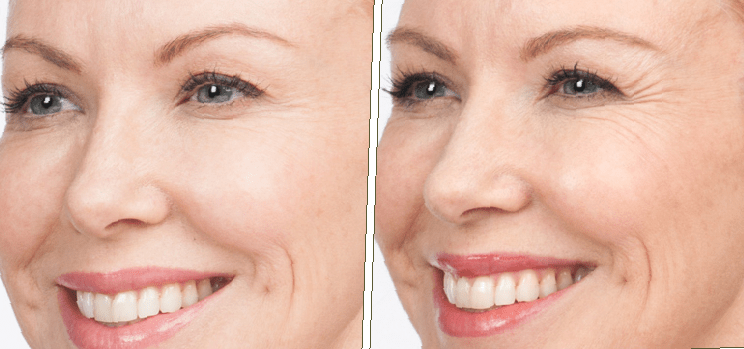 botox-before-and-after-crows-feet-29