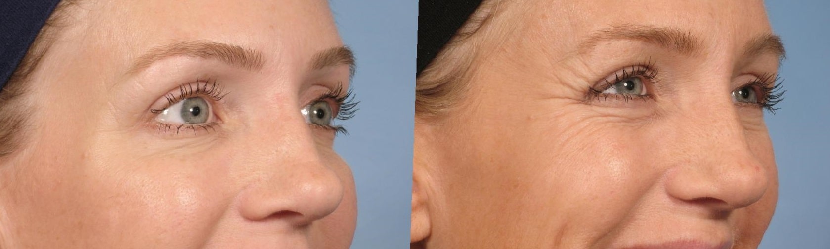 botox-before-and-after-crows-feet-30