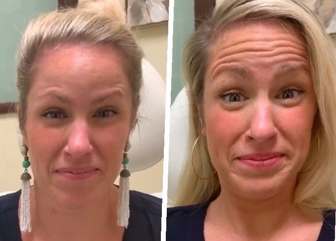 botox-before-and-after-forehead-25
