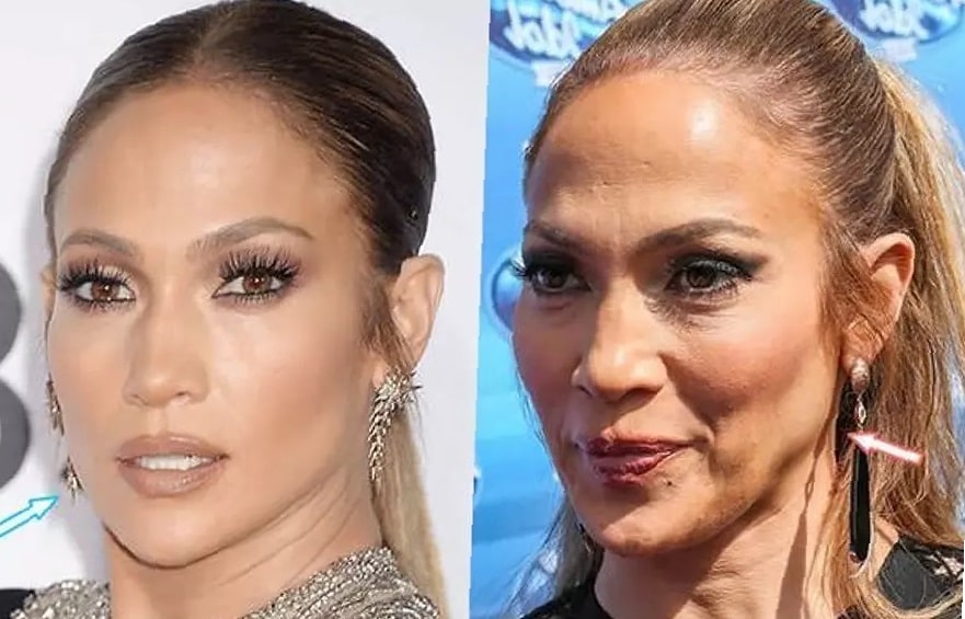 botox-before-and-after-forehead-26