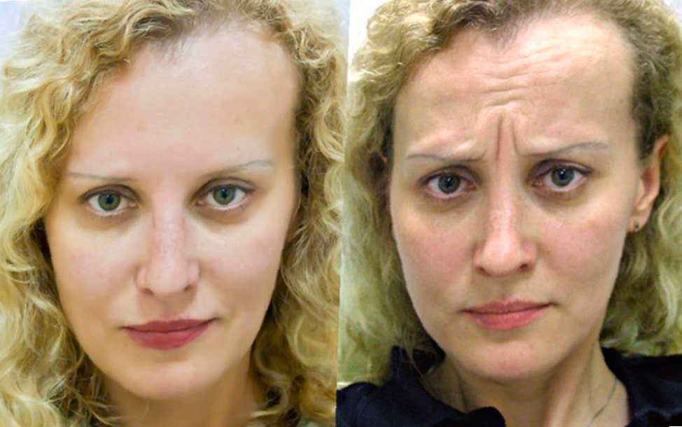 botox-before-and-after-forehead-29