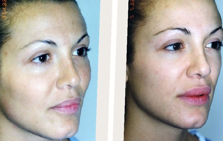 cheek-implants-before-and-after-1